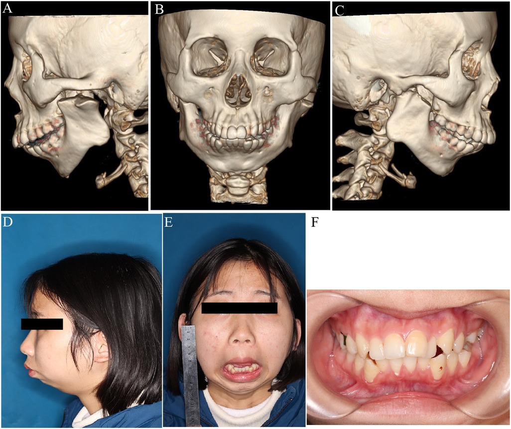 Three-dimensional CT images (A-C) show lateral and frontal views of a skull with dental alignment and jaw structure. Two photographs (D-E) depict a person in profile and frontal view with black bars over their eyes. Image (F) shows an open mouth with visible teeth and gums.
