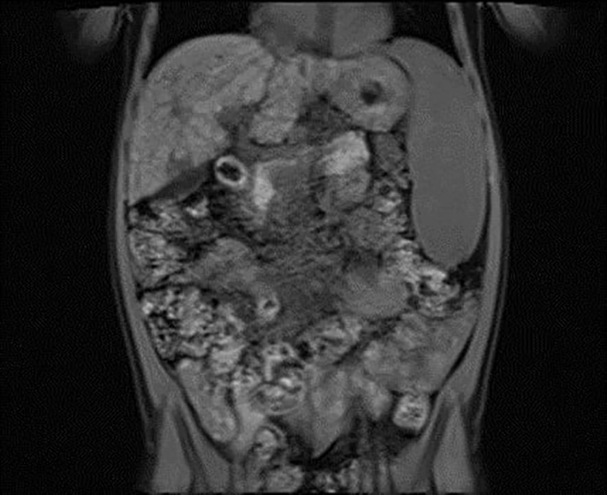 MRI scan showing a cross-sectional view of the abdomen, displaying organs and tissues. Multiple dark and light areas indicate varying densities, with detailed visualization of an internal mass and surrounding structures.