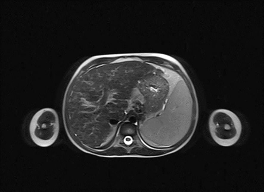 MRI scan of the abdomen showing a transverse section. The image displays liver tissue with varying shades of gray representing different densities. Darker areas may suggest denser tissue. Light and dark patterns are present, indicating normal and abnormal structures.