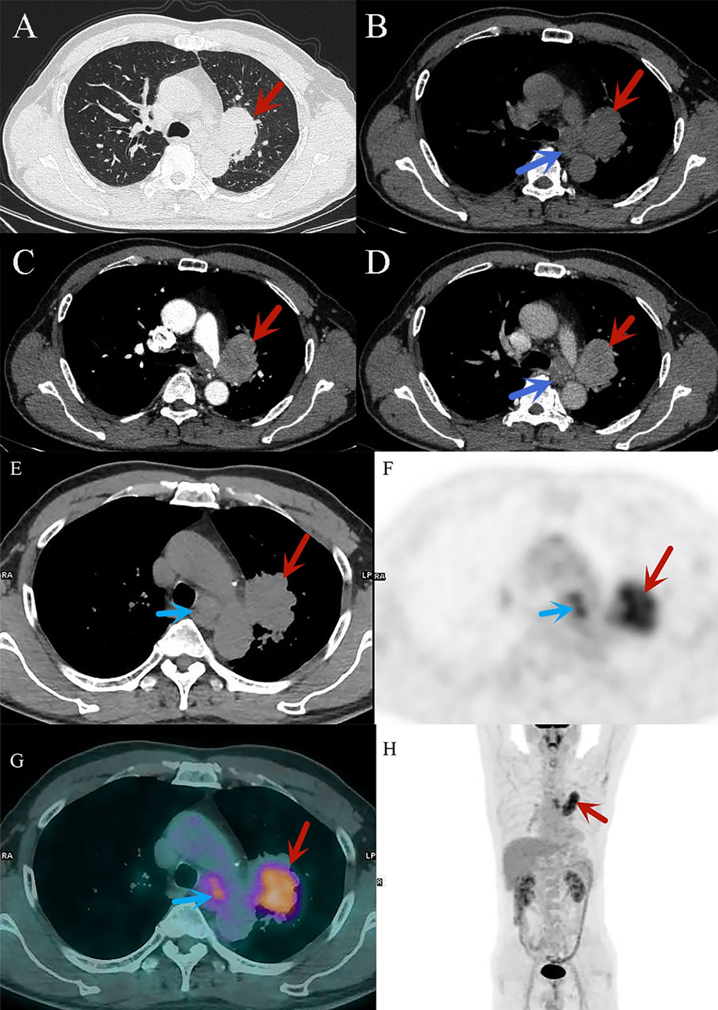 CT and PET scan images of a chest, showing a mass indicated by red arrows in various slices from different angles. Blue arrows point to another area of interest, possibly a lymph node. The images highlight the presence and metabolic activity of a lesion, with prominent contrast and differing shades indicating tissue density and function.