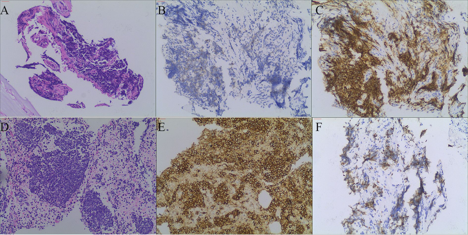 Histopathological slides labeled A to F show tissue samples stained with different techniques. Slides A and D are stained in shades of purple, likely using hematoxylin and eosin. Slides B and F show a lighter, bluish staining, while slides C and E feature a brown staining, possibly indicating immunohistochemical processes. Each slide displays varying textures and patterns of the tissue samples.