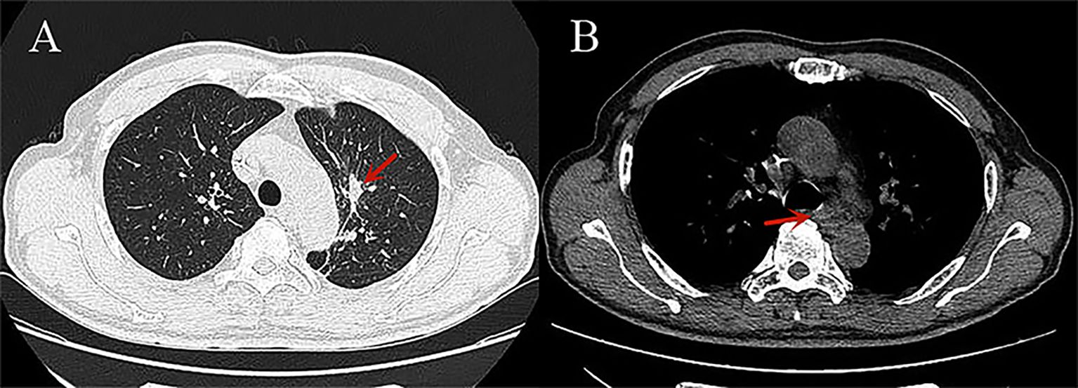 CT scan with two panels labeled A and B shows transverse chest slices. Panel A highlights a nodule in the right lung with a red arrow. Panel B highlights a different area within the thoracic region using a red arrow.