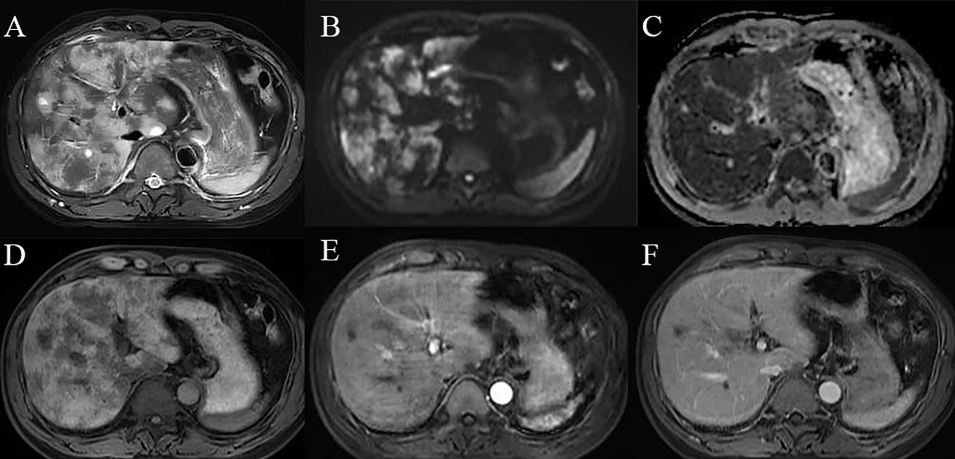 Series of six MRI scans labeled A to F, showing different sections of the abdominal area. Each image highlights variations in tissue density and structure, with some bright and dark regions suggesting possible abnormalities or differing tissue types. Images appear to emphasize liver and surrounding organs for diagnostic purposes.