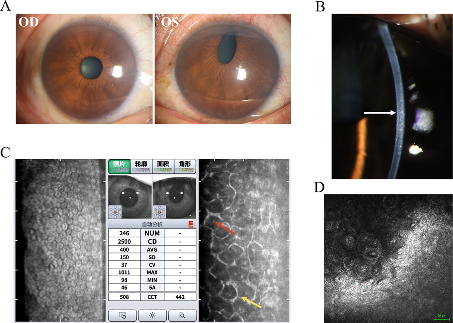 Panel A shows close-up images of a person's eyes, labeled OD and OS, revealing brown irises. Panel B is a slit-lamp photograph with an arrow pointing to the corneal surface. Panel C includes a digital analysis display with corneal endothelium images, annotated with red and yellow arrows pointing to specific areas. Panel D displays a detailed view of corneal microstructures.