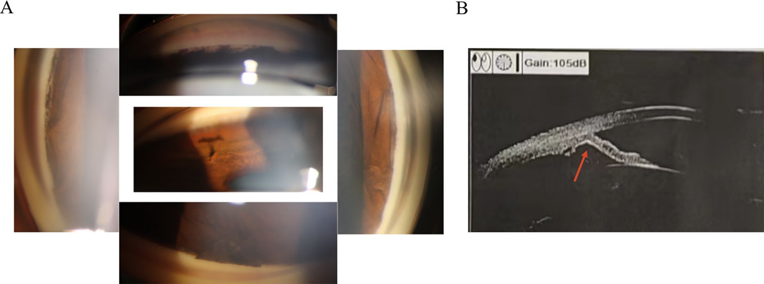 Panel A displays images of an eye's corneal detail, likely illustrating an irregularity or condition. Panel B shows an ultrasound image of the eye with an orange arrow pointing to a specific area, possibly indicating a notable feature or anomaly.