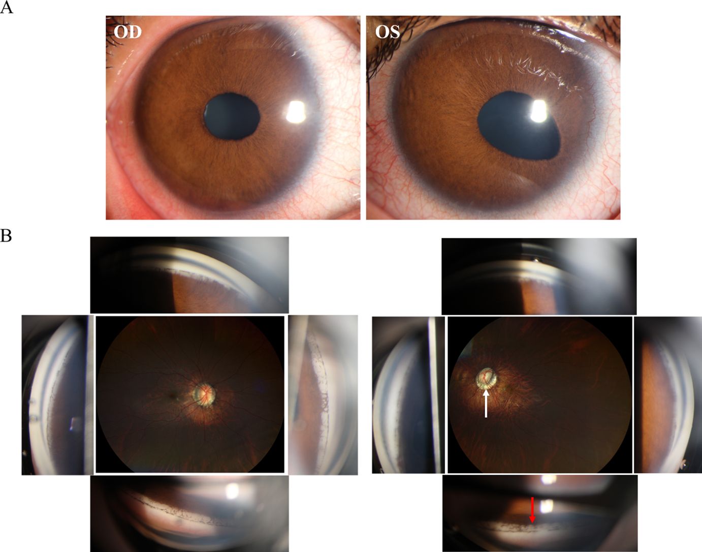 Panel A shows close-up images of the right eye (OD) and left eye (OS) with brown irises. Panel B contains multiple images of different eye examinations, including detailed views of the retina and other eye structures. A white arrow highlights a specific area in one image, and a red arrow points to another detail in a different image.
