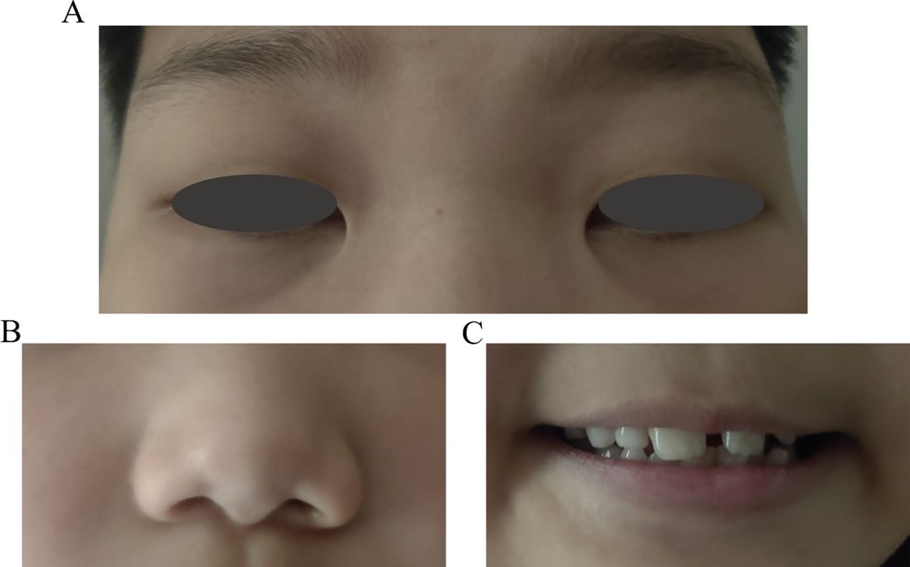 Three-part image showing facial features. A: Close-up of the eyes with black ovals obscuring them. B: Close-up of the nose. C: Close-up of a smile displaying several teeth.