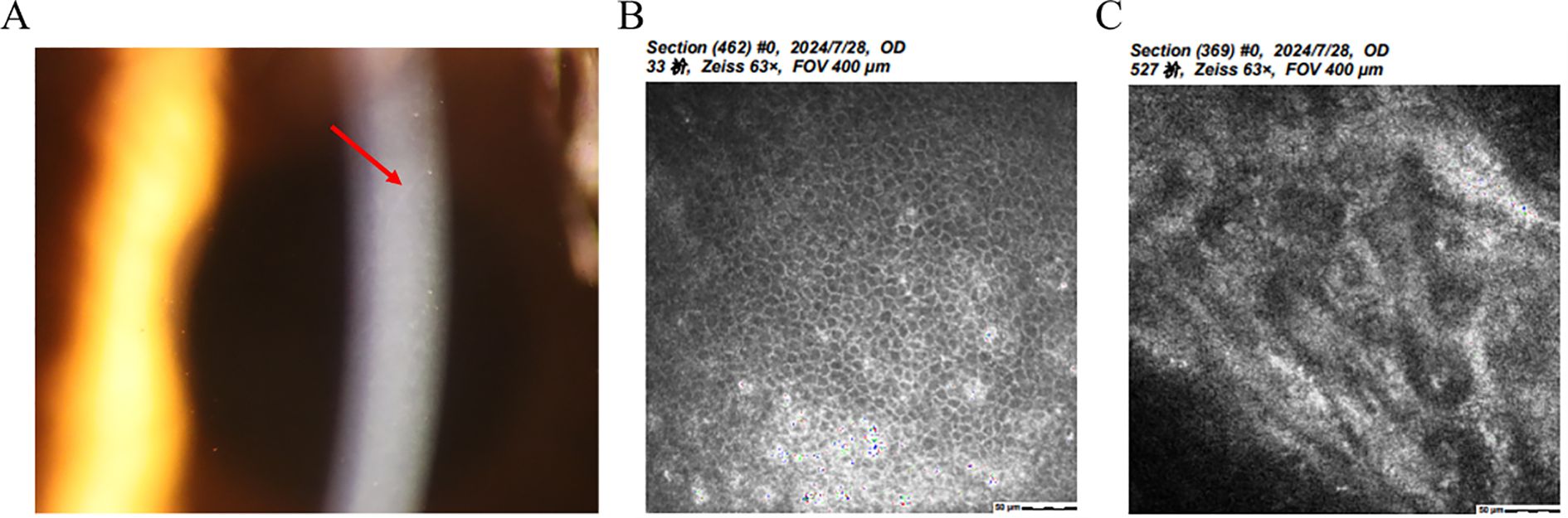 Panel A shows a slit lamp image of a corneal section with a red arrow pointing to a specific area. Panel B presents a microscopic view showing a dense cellular pattern. Panel C displays a microscopic image illustrating a less defined, irregular texture. Both microscopic images are at sixty-three times magnification with a field of view of four hundred micrometers.