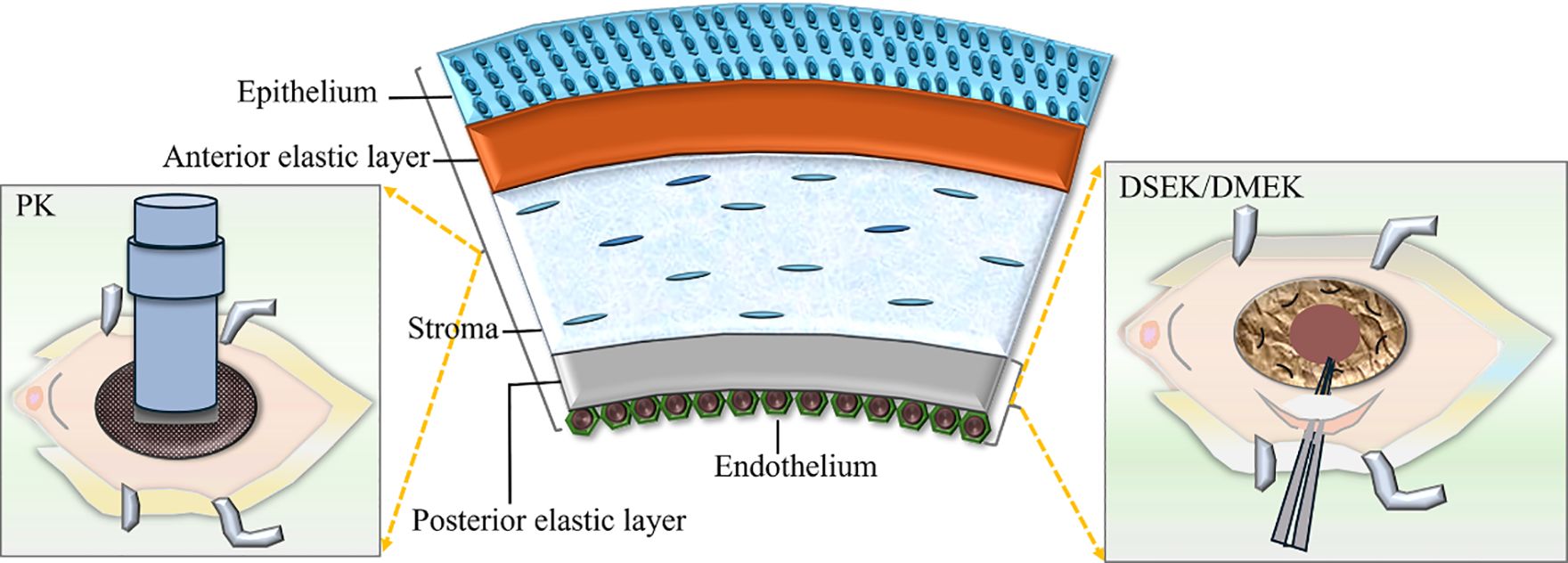 Cross-sectional diagram of the cornea shows labeled layers: epithelium, anterior elastic layer, stroma, and endothelium. Insets illustrate procedures: PK with cylindrical tool and DSEK/DMEK with circular disc removal.