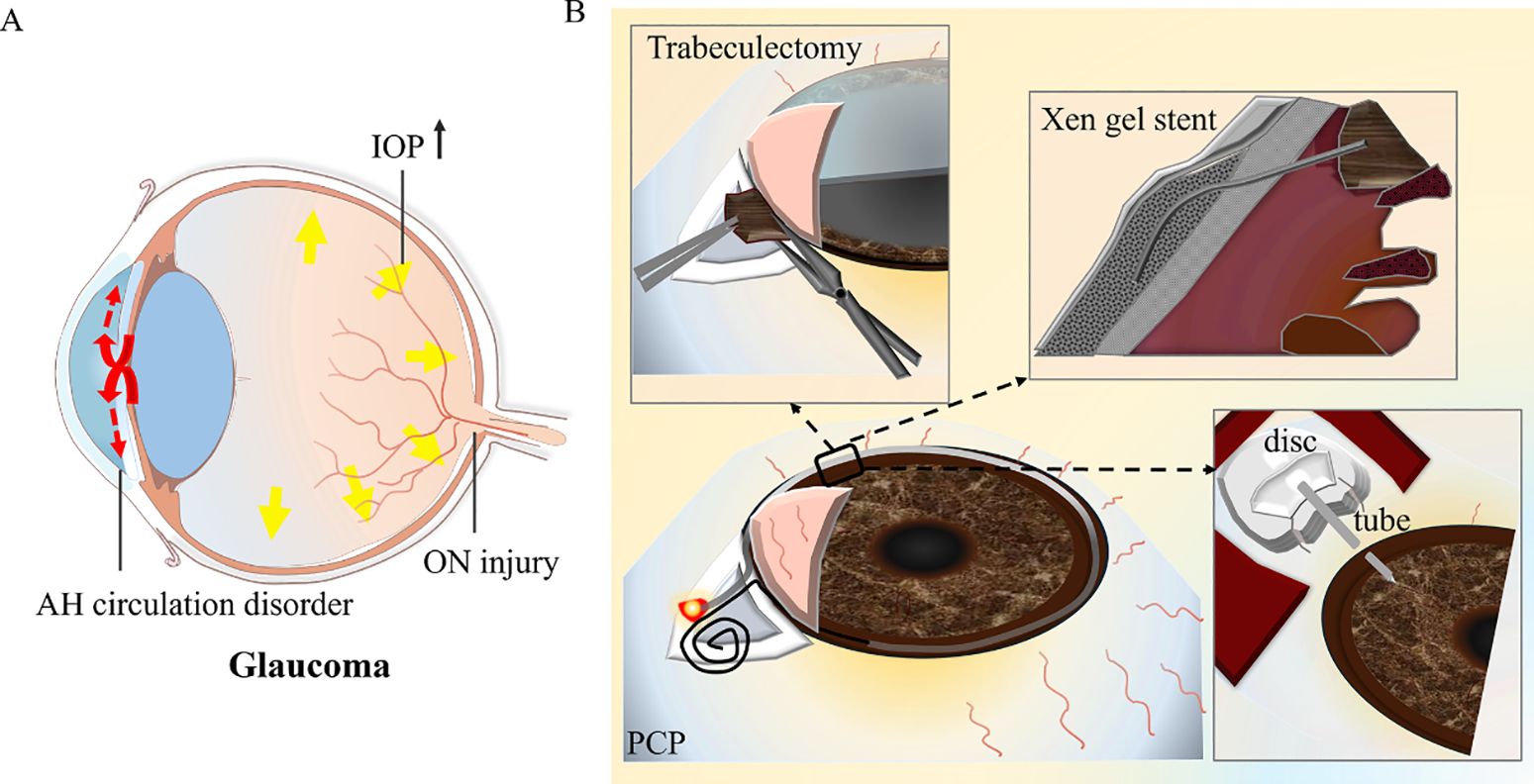 Diagram illustrating glaucoma. Panel A shows a cross-section of the eye with arrows indicating disrupted aqueous humor circulation and increased intraocular pressure, leading to optic nerve injury. Panel B depicts surgical interventions, including trabeculectomy, Xen gel stent insertion, and a disc tube placement, to alleviate eye pressure.