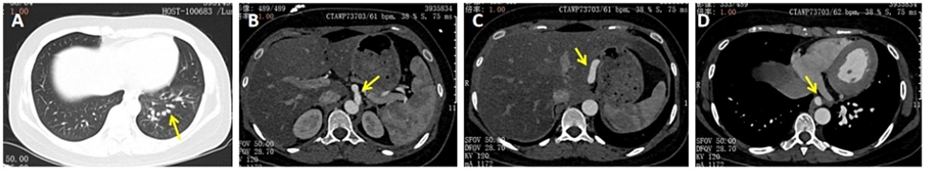 CT scan series labeled A to D, showing different cross-sectional views of the thorax and abdomen. Each image has a yellow arrow indicating specific areas of interest. The scans highlight changes or abnormalities in the tissue density and organ positioning across the sections.