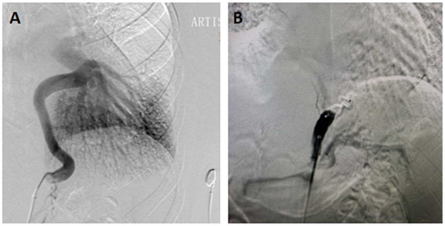 Two-panel angiography image. Panel A shows a detailed view of the blood vessels, highlighting a clear passage. Panel B displays a narrowed or blocked area with reduced contrast flow, indicating a restriction in the vessels.