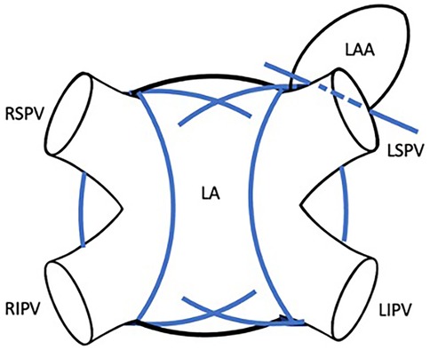Diagram illustrating the anatomy of the left atrium (LA) with surrounding pulmonary veins: right superior pulmonary vein (RSPV), right inferior pulmonary vein (RIPV), left superior pulmonary vein (LSPV), left inferior pulmonary vein (LIPV), and the left atrial appendage (LAA). Blue lines indicate paths or electrical circuits around these structures.