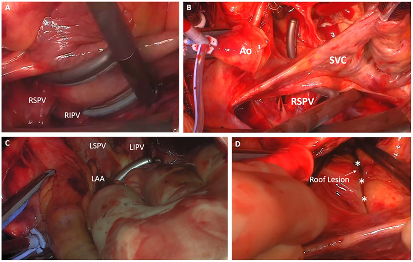 Surgical images showing various stages of a cardiac procedure. \n\nPanel A displays the right superior and inferior pulmonary veins labeled as RSPV and RIPV. \n\nPanel B shows the aorta (Ao), superior vena cava (SVC), and right superior pulmonary vein (RSPV). \n\nPanel C identifies the left superior and inferior pulmonary veins (LSPV and LIPV), along with the left atrial appendage (LAA). \n\nPanel D illustrates a roof lesion with three marked areas, indicated by asterisks.