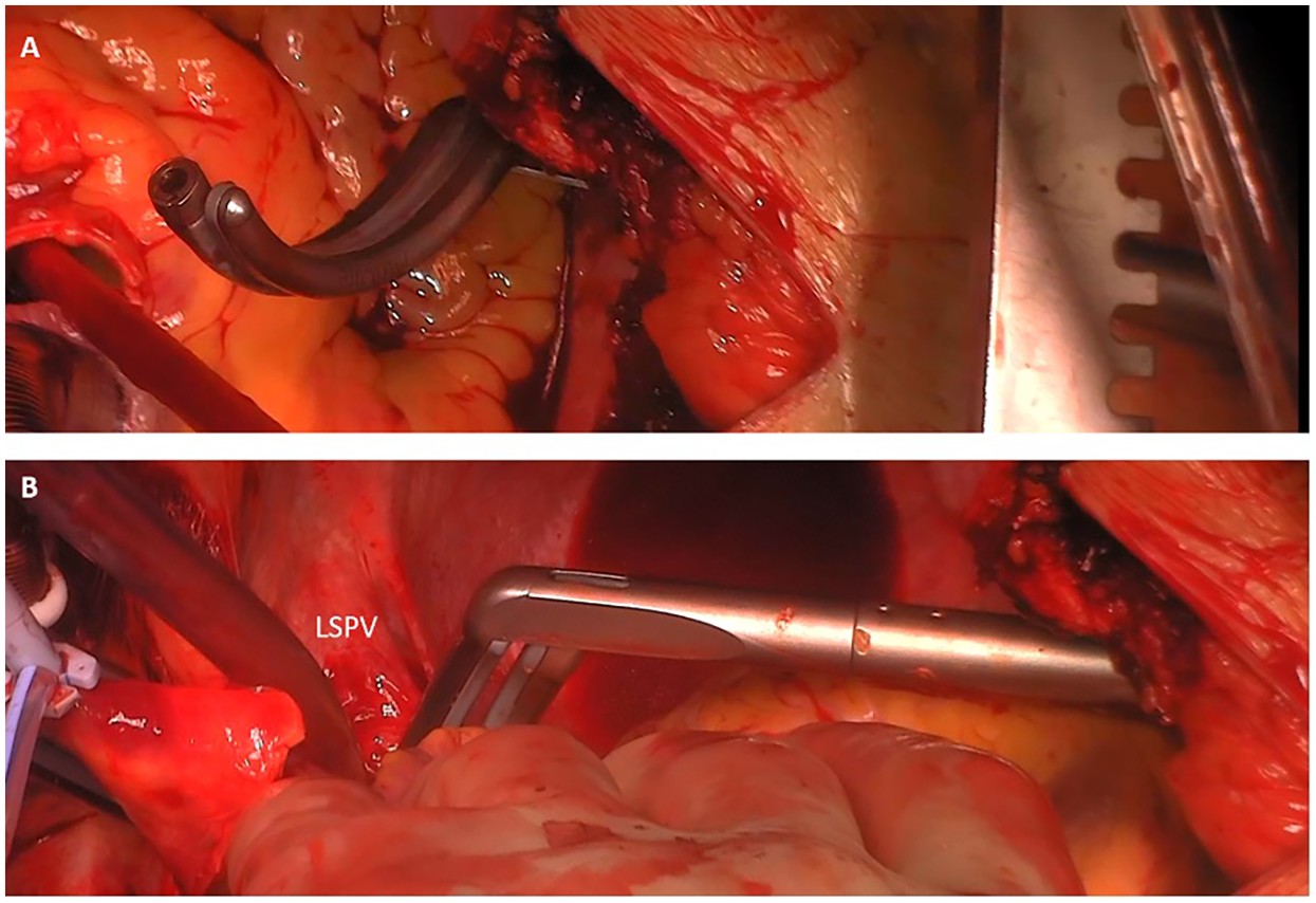 Surgical images show procedures involving internal organs. Image A displays surgical tools in an open cavity with visible fatty tissue. Image B focuses on the LSPV area with clamps and instruments manipulating tissue.