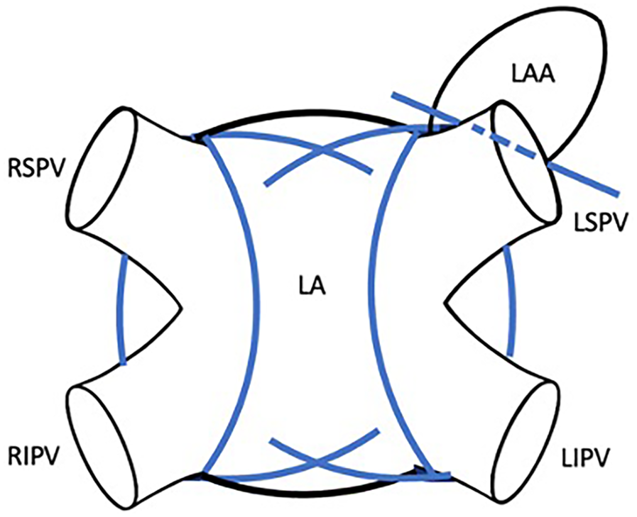 Diagram illustrating the anatomy of the left atrium (LA) with surrounding pulmonary veins: right superior pulmonary vein (RSPV), right inferior pulmonary vein (RIPV), left superior pulmonary vein (LSPV), left inferior pulmonary vein (LIPV), and the left atrial appendage (LAA). Blue lines indicate paths or electrical circuits around these structures.
