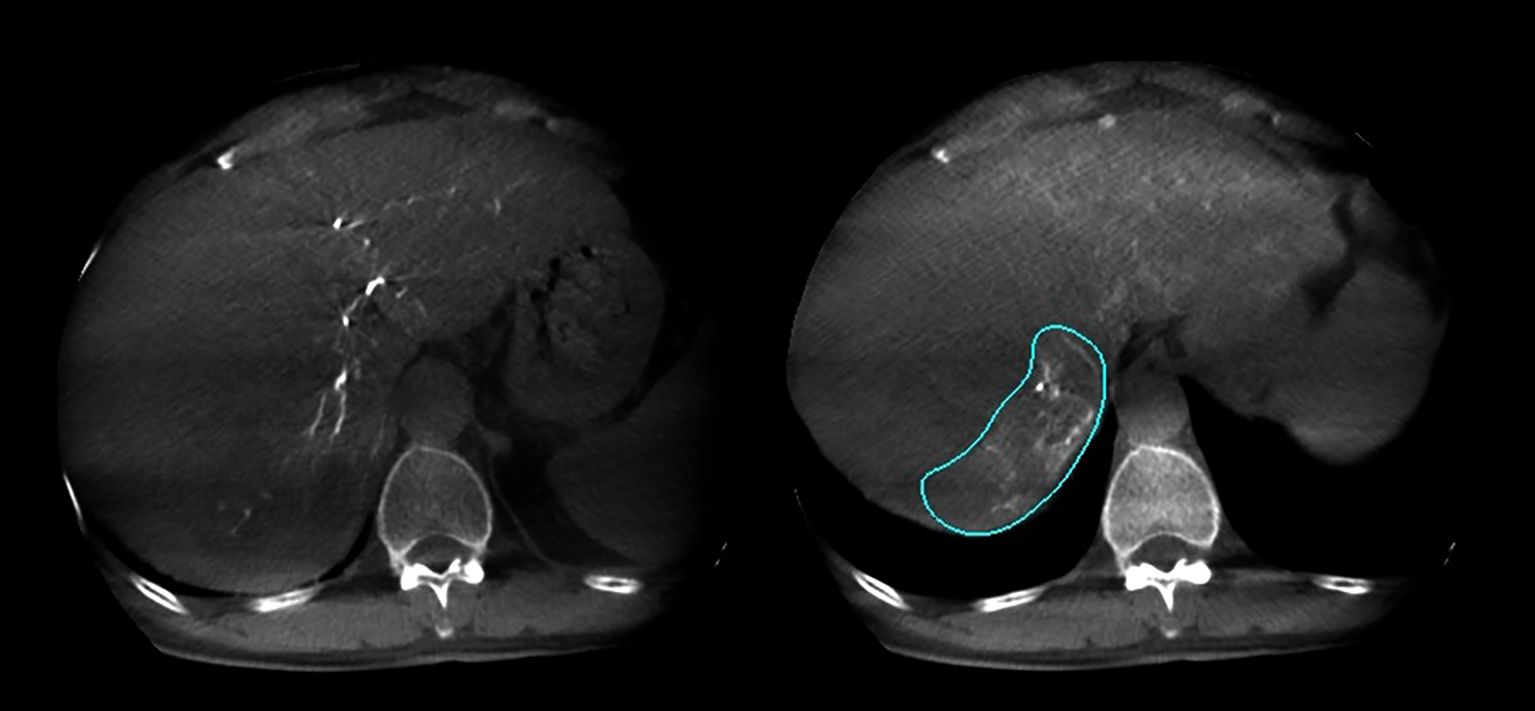 CT scan showing two axial images of the liver. The left image shows a normal liver appearance. The right image highlights a section with an irregular outline, possibly indicating a lesion or anomaly.