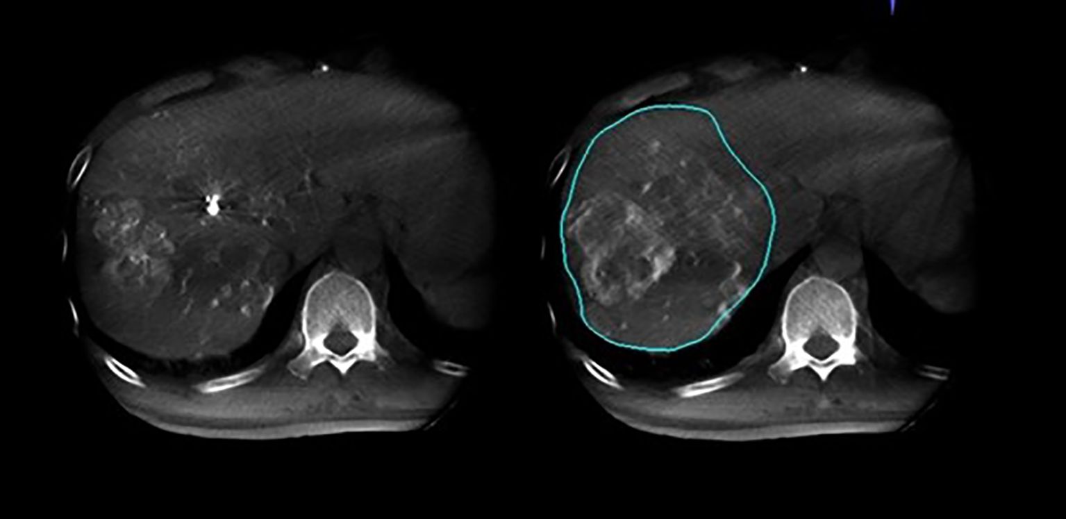 CT scan images showing axial views of a liver. The right image highlights a large liver tumor with a blue outline, while the left shows the tumor without the outline. Both images display the spine and surrounding organs in grayscale, with variations in tissue density.