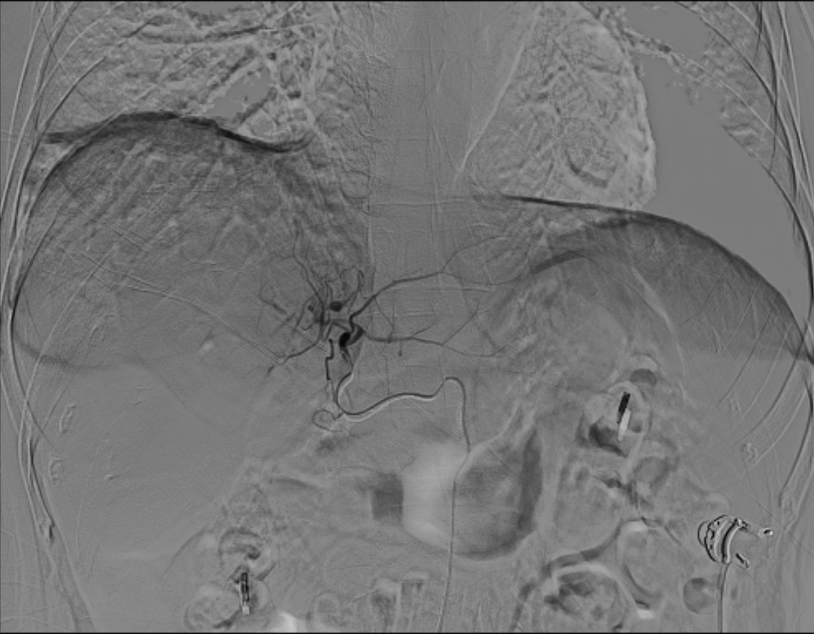 Angiographic imaging of the human abdomen, showing the vascular structures with contrast highlighting the blood vessels. The aorta and major branches are visible in a grayscale format, providing detailed insights into the vascular anatomy and any potential abnormalities.