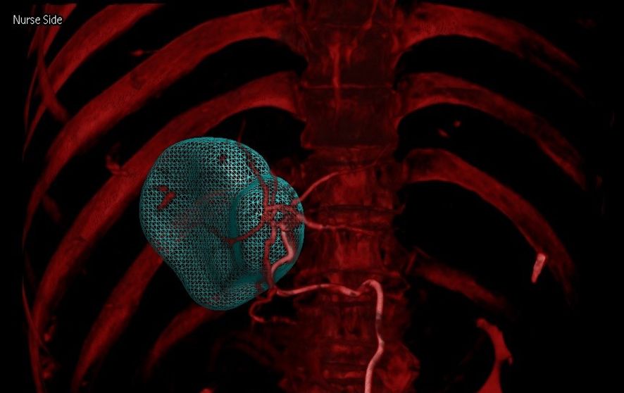CT scan showing a 3D rendering of a human thorax in red, with a teal mesh structure highlighting an area within the chest cavity.