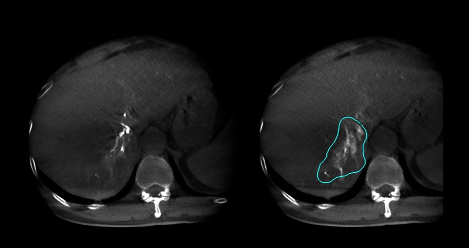 CT scan of the liver featuring two panels. The left panel shows an unmarked liver image, while the right panel highlights a liver lesion with a blue outline, indicating an abnormality.