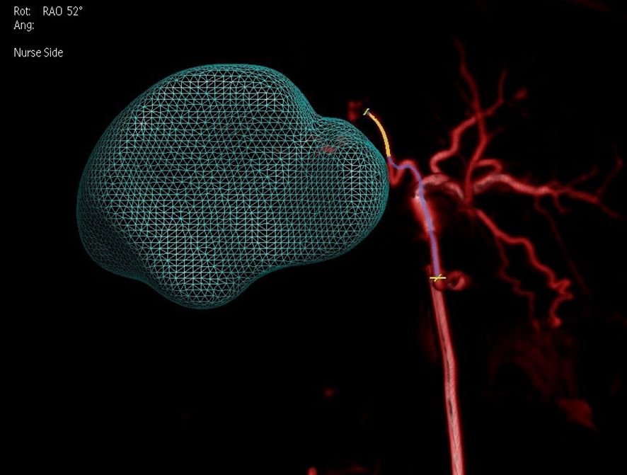 Medical imaging illustration showing a three-dimensional, translucent mesh structure in teal overlaying an arterial network in red. The background is dark, with some annotations in white text indicating rotation angle and perspective.