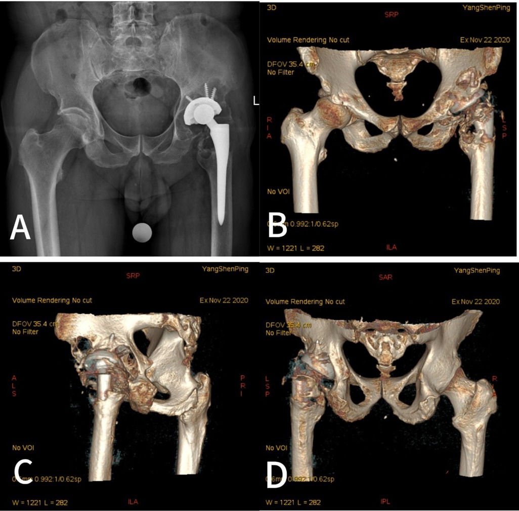 X-ray and 3D CT images showing a hip joint replacement. Image A is an X-ray of the pelvis with the artificial hip joint visible. Images B, C, and D are 3D CT scans displaying various angles of the hip and surrounding bones, highlighting the placement and integration of the prosthetic hip.