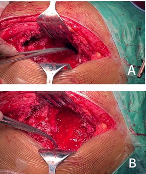 Two clinical images labeled A and B show an open surgical procedure on human tissue. Both images display a deep incision with retractors holding the wound open, revealing underlying tissues. Surgical instruments are visible, and there is a sterile drape surrounding the area.