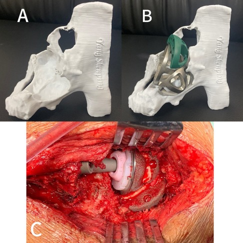 Panel A shows a 3D-printed model of a bone structure. Panel B displays the same model fitted with a metal and plastic implant. Panel C depicts an open surgical site with an implanted joint visible among tissue and surgical instruments.