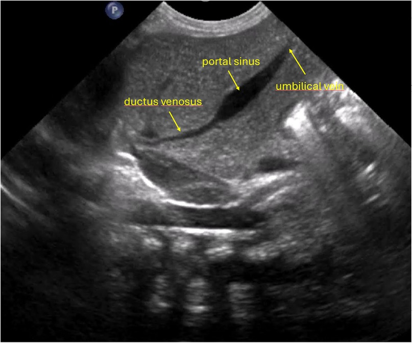 Ultrasound image displaying the liver of the newborn. Labeled structures include the ductus venosus, portal sinus, and umbilical vein. The labels are in yellow, with arrows pointing to each respective structure.