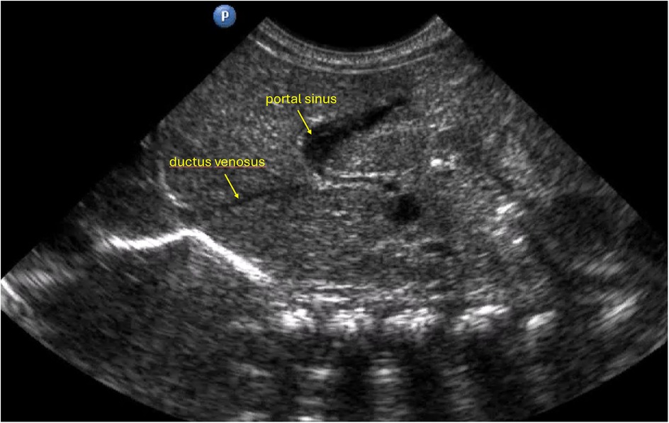 Ultrasound image showing newborn anatomy with labeled structures.