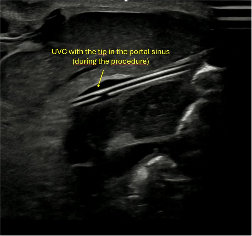 Ultrasound image showing the tip of an umbilical venous catheter (UVC) positioned in the portal sinus during the procedure.