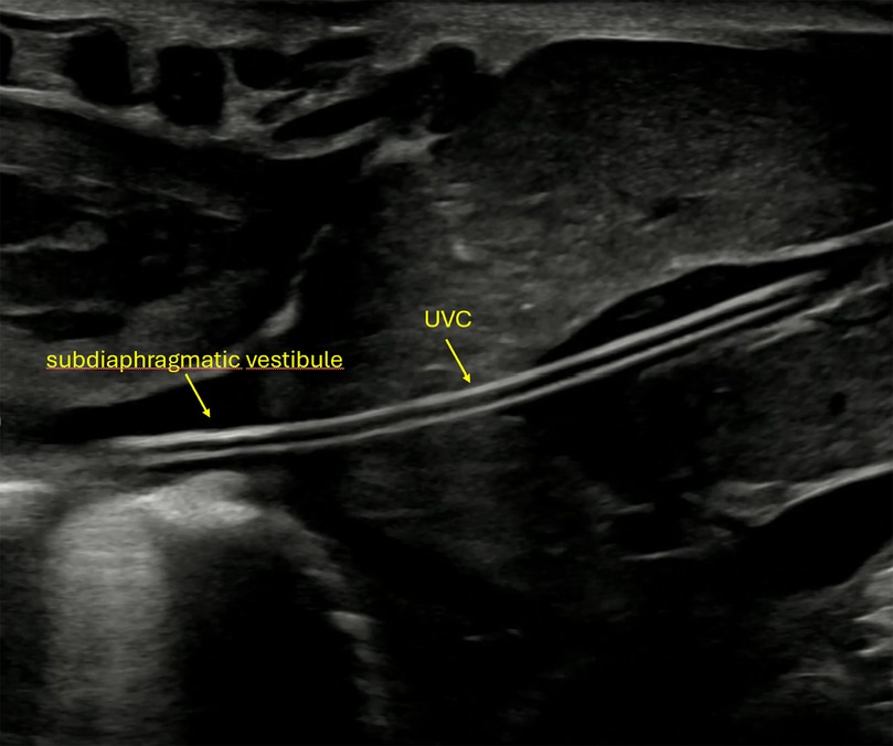 Ultrasound image showing the tip of the umbilical venous catheter (UVC) in the correct position in the subdiaphragmatic vestibule. Yellow arrows and labels identify each structure.