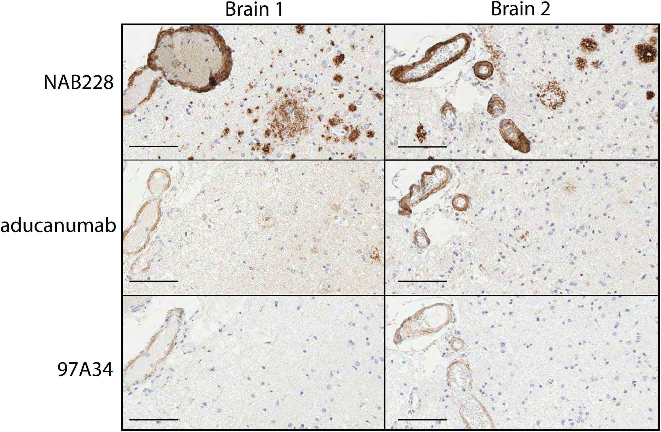 Microscopic images compare two brains labeled as Brain 1 andBrain 2 across three antibody treatments: NAB228, aducanumab, and 97A34. The top row shows higher plaque densities with NAB228. Plaque presence decreases with aducanumab and is least in 97A34 treatments. Black scale bars are present.