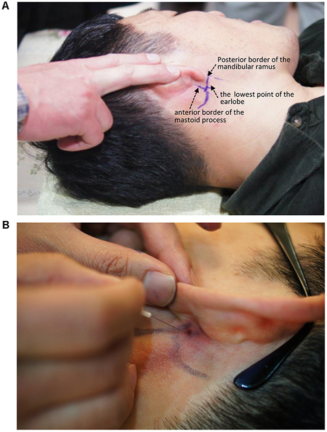 Top image shows a person lying down with a hand pointing to the area behind the ear, labeled with anatomical landmarks: posterior border of the mandibular ramus, lowest point of the earlobe, and anterior border of the mastoid process. Bottom image depicts a close-up of a needle being inserted near the same area behind the ear, with a hand holding the needle and part of the ear visible.