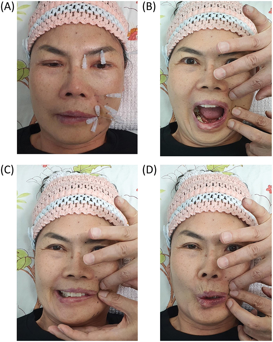 Four images depict a woman undergoing facial exercises or treatment while wearing a pink crocheted headband. (A) Shows small adhesive strips on her face in a symmetrical pattern. (B) Displays her opening her mouth wide with fingers placed around it. (C) Shows her slightly smiling with her hand framing her mouth. (D) Exhibits her pursing her lips with similar hand placement.