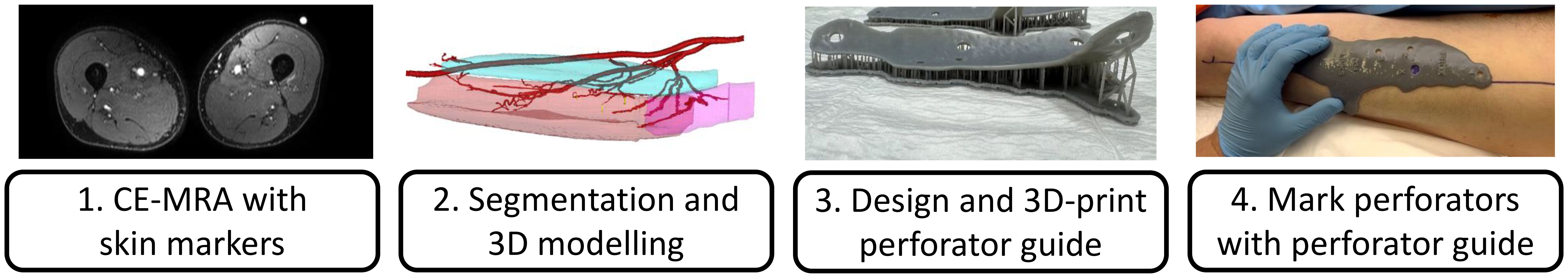 CE-MRA showing cross-sections with skin markers. 2. 3D modeling illustrates segmented vascular structures and muscles. 3. A 3D-printed perforator guide with multiple holes for MRI marker locations and perforator locations. 4. A gloved hand marks a patient's skin using the guide.