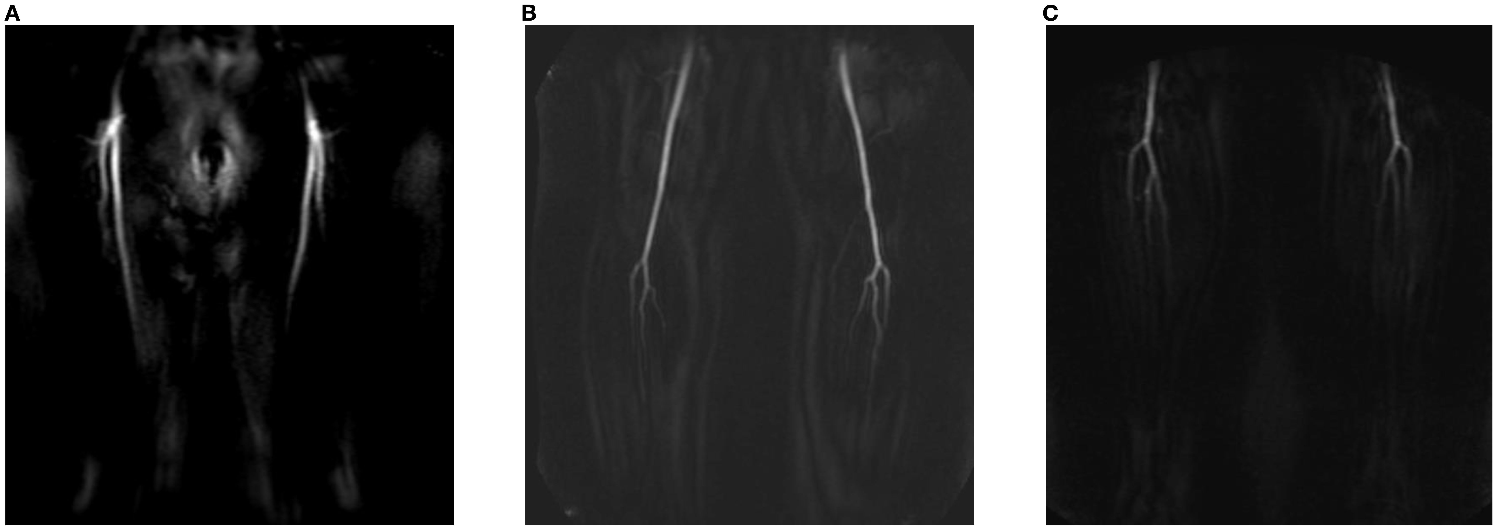 Three-panel MRI images of the lower body, labeled A, B, and C. The panels show the moment that the dynamic MRI scan should be started. Panel A shows a front view of the pelvis and upper legs, highlighting contrast filling of the femoral arteries. Panel B focuses on the lower leg's vascular structure with filling of the femoral and popliteal artery. Panel C displays the lower leg vascular structures with filling of the popliteal trifurcation.