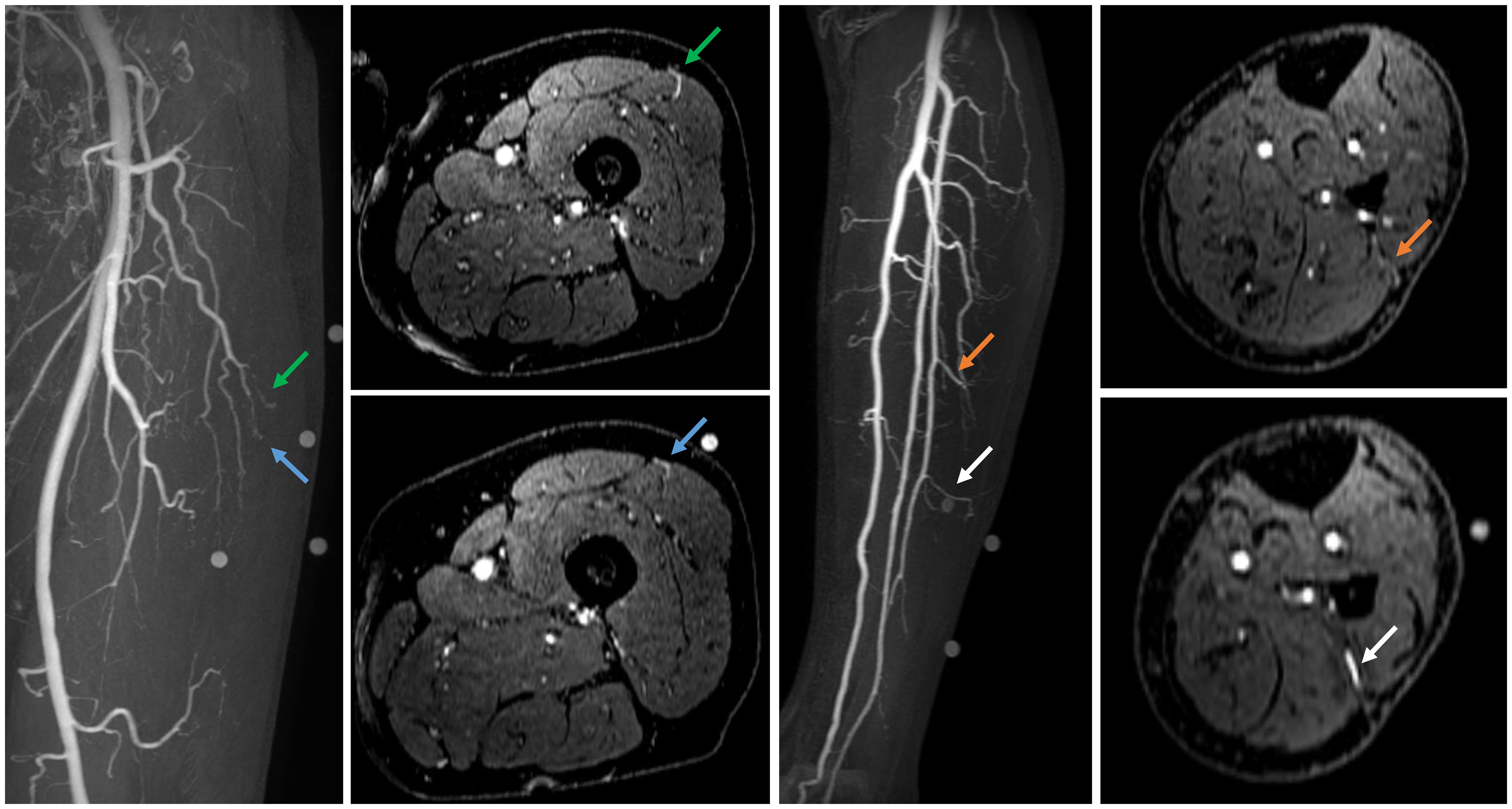 Medical imaging showing multiple scans of a leg. The images include MRI scans with arrows in green, blue, orange, and white, highlighting specific areas of interest along arteries. The images display both longitudinal and cross-sectional views of the leg.