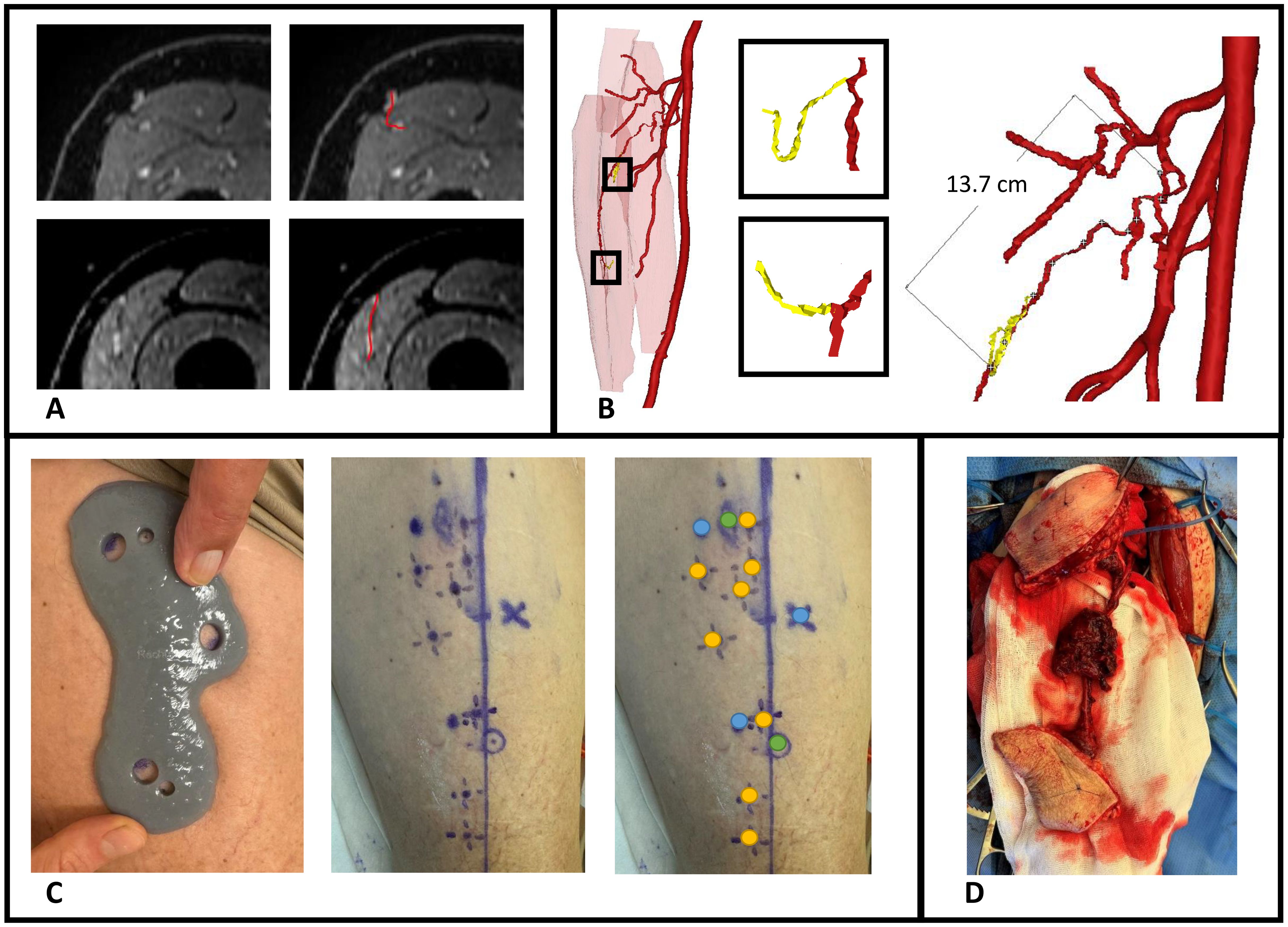 A series of medical images showing different stages of surgical planning and procedure. Panel A: MRI scans with highlighted areas. Panel B: Threedimensional vascular graphics with arteries marked in red and highlighted sections in yellow, indicating a 14 cm pedicle length measurement. Panel C: A silicone mold applied on skin, marking sites with ink, and placement of blue, orange, and green markers. Panel D: A post-surgical view with exposed tissue and instruments on a surgical drape.