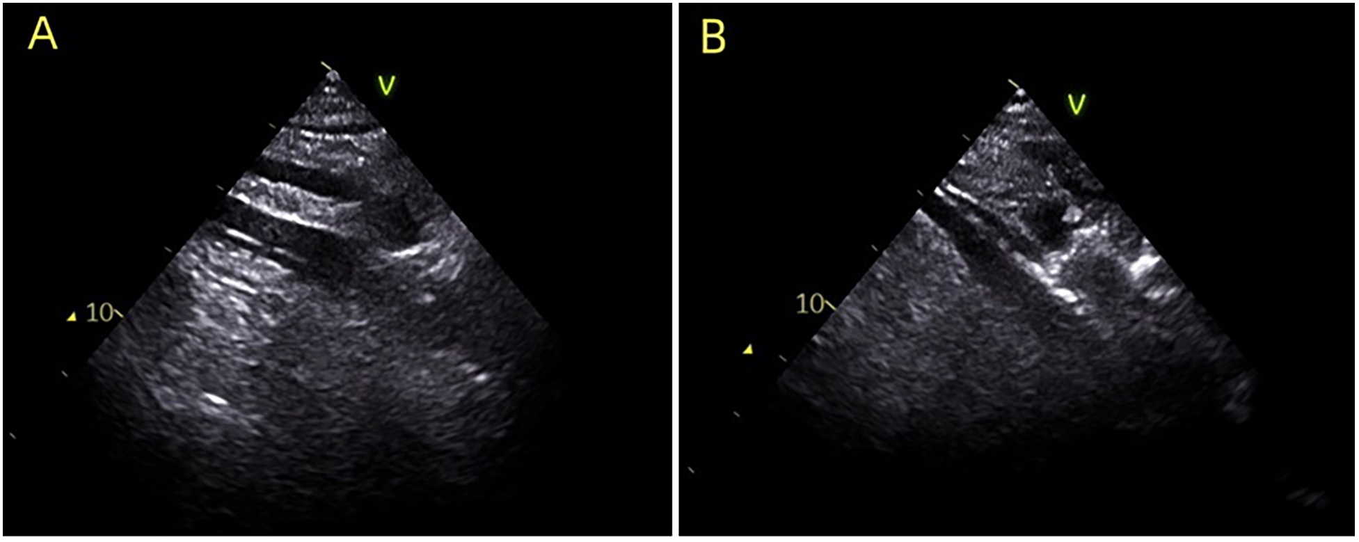 Ultrasound images labeled A and B display internal structures with varying densities and textures. Both images feature a triangular view marked with a \"V\" at the top and the number \"10\" at the side, indicating scale or depth. Image A shows distinct horizontal lines, while image B presents a more varied texture with irregular patterns.