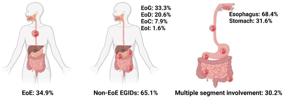 Diagram showing three human figures with highlighted digestive tracts. The left figure shows EoE affecting 34.9%. The middle figure indicates non-EoE EGIDs at 65.1%, with Esophagus, Stomach, and Intestines highlighted showing percentages: Esophagus 33.3%, Stomach 20.6%, Colon 7.9%, Ileum 1.6%. The right figure illustrates multiple segment involvement at 30.2%, with percentages: Esophagus 68.4%, Stomach 31.6%.