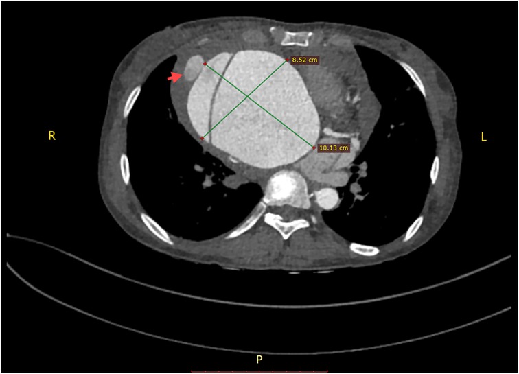 CT scan of the chest showing a large mass in the right thoracic cavity. The mass is measured with green lines indicating dimensions of 8.52 centimeters and 10.13 centimeters. A red arrow points to a smaller round structure adjacent to the mass. Labels \