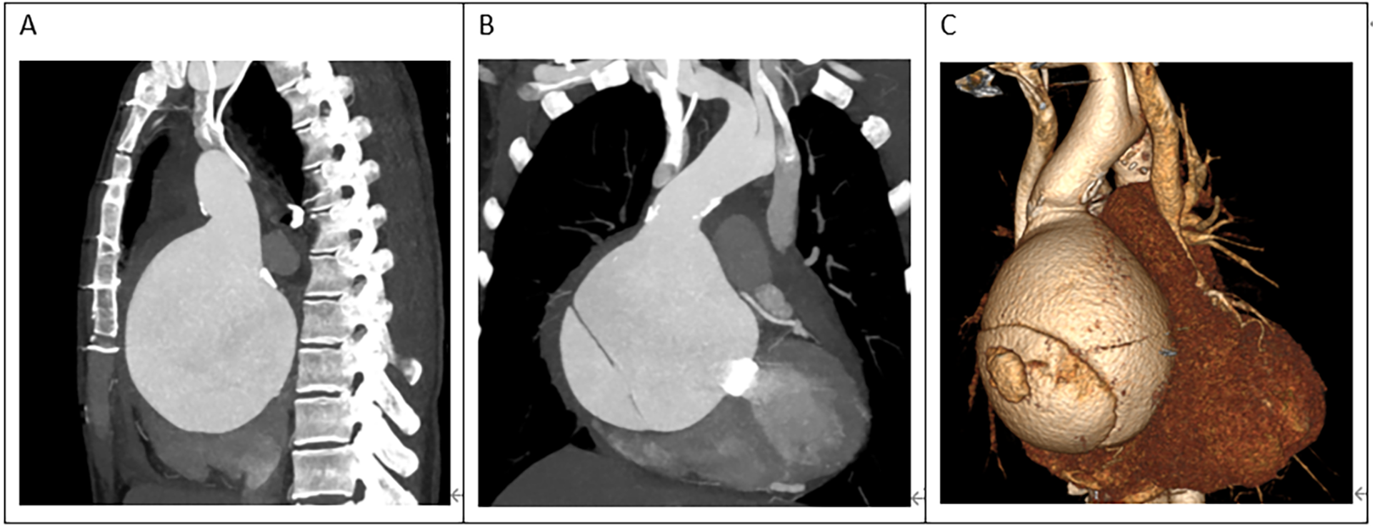 CT scans and a 3D reconstruction of an ascending aortic aneurysm. Image A shows a sagittal view, Image B presents a coronal view, and Image C provides a 3D rendered anterior view of the enlarged aorta.