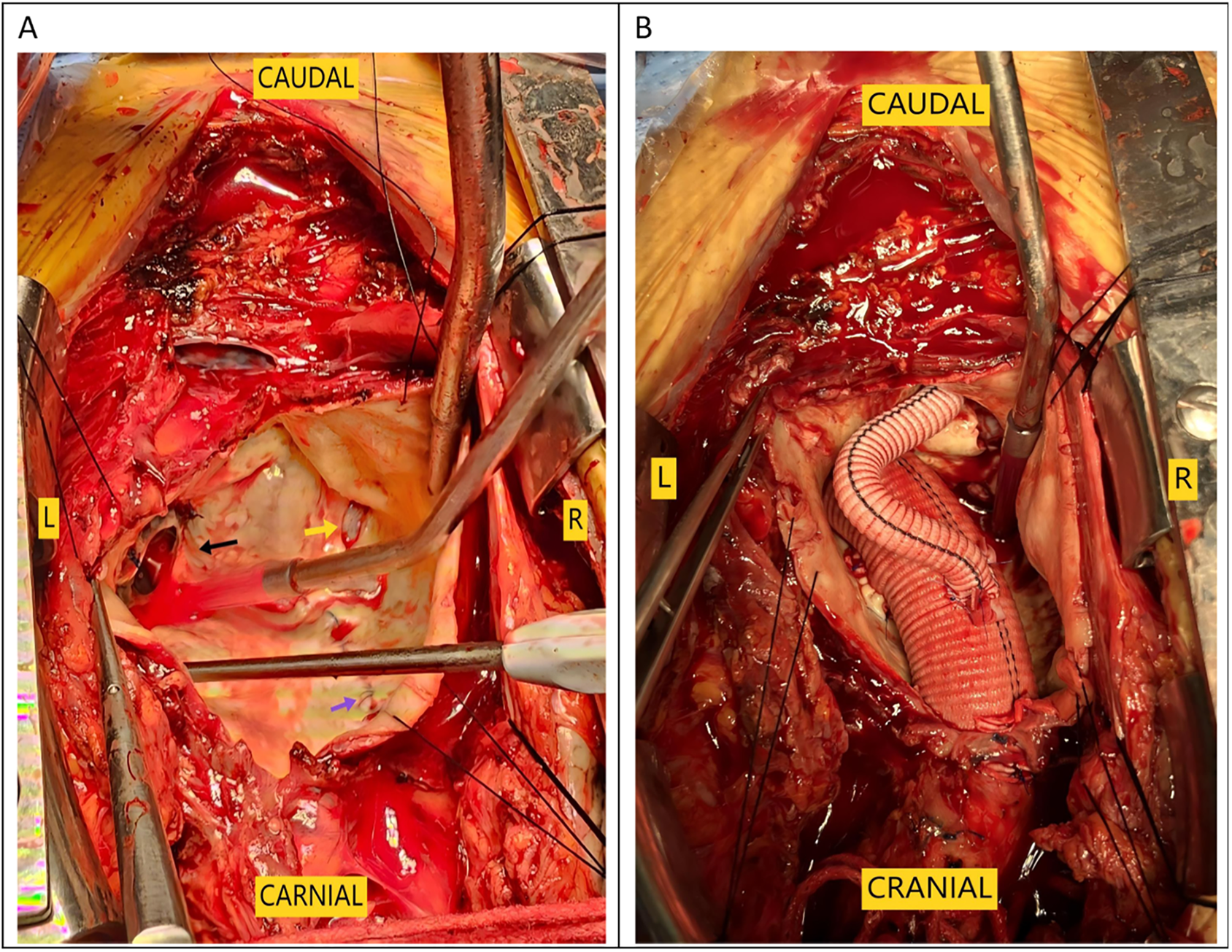 Surgical image showing an open wound with visible tissue and instruments. Labels indicate directions: \"Caudal\" at the top, \"Carnial\" at the bottom, \"L\" on the left, and \"R\" on the right. Colored arrows highlight specific areas: a black arrow, yellow arrow, and purple arrow are visible.