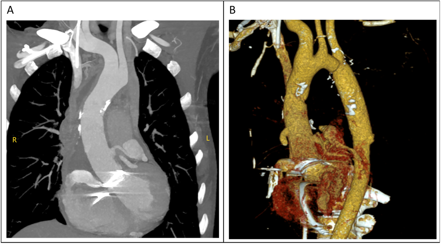 Surgical view showing an open cavity with a prosthetic conduit in place. Labels indicate the orientation: caudal at the top, cranial at the bottom, left and right sides are marked. The area is surrounded by tissue and surgical instruments.