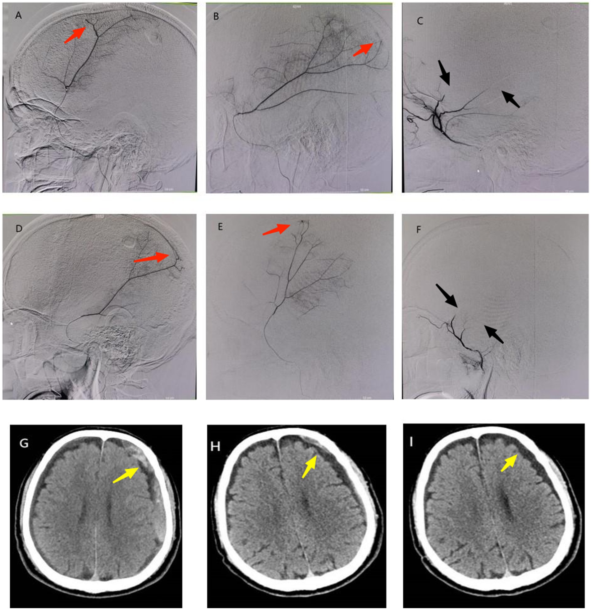 Six images show angiographic views (A-F) of cerebral arteries with red and black arrows pointing to specific sections. Three imagesd (G-l) display CT scans of the brain with yellow arrows highlighting areas of interest, indicating absorbtion of subdural hematoma.