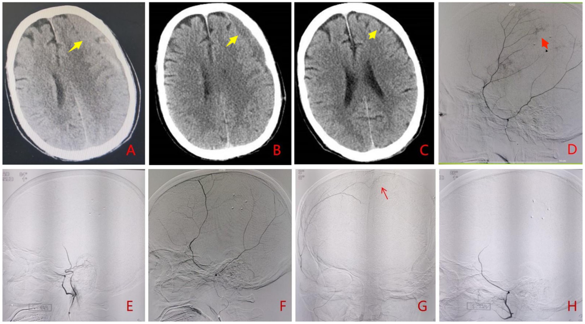 A series of medical imaging scans labeled A to H. Images A, B, and C show CT scans of a brain with arrows indicating specific areas of interest. Images D to H are angiograms displaying blood vessels with arrows pointing to particular sections. Each scan highlights different features for analysis.