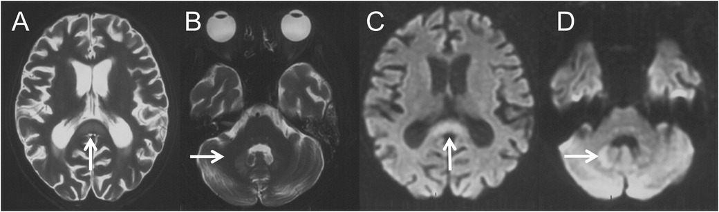 MRI scans with four labeled images. Image A shows a transverse brain section with an arrow pointing to the splenium of corpus callosum. Image B displays a transverse section highlighting the dentate nucleus with an arrow. Image C shows another transverse brain section with an arrow pointing to the splenium of corpus callosum. Image D displays a transverse section with an arrow pointing to the dentate nucleus.