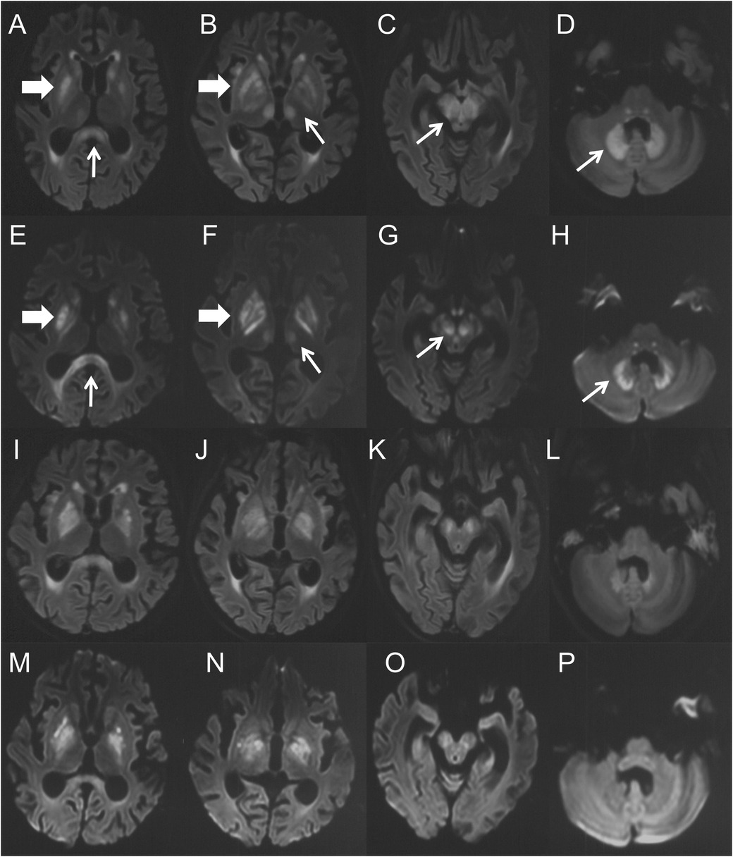 A series of MRI brain scans labeled A to P show bilateral lesions in the thalamus, basal ganglia, and midbrain across different sections. Arrows highlight these lesions, indicating areas of abnormality.